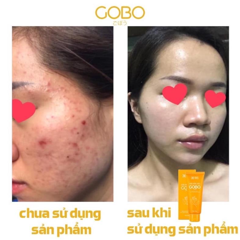 SỮA RỬA MẶT LÀM SẠCH SÂU NGĂN NGỪA MỤN GOBO COCAYHOALA 100g | BigBuy360 - bigbuy360.vn