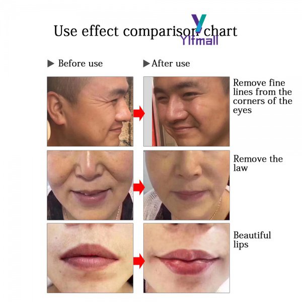 Bút Tiêm Axit hyaluronic Áp Suất Cao