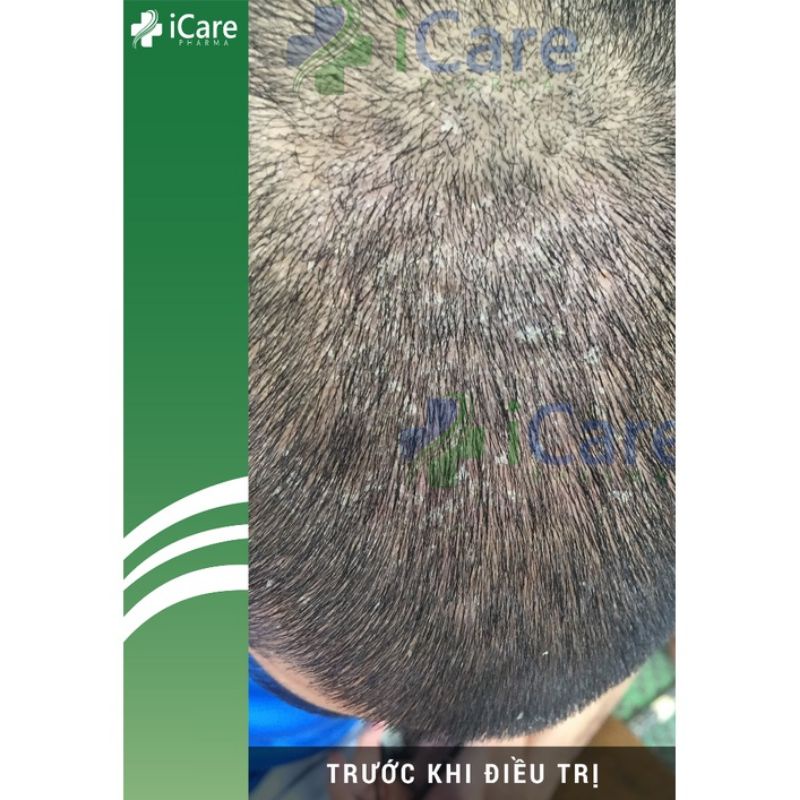 Ezema 50 icare dược liệu nấm chiết xuất dược liệu Ấn Độ