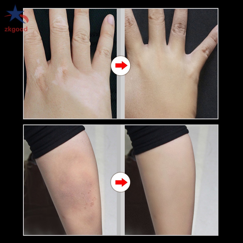 Bộ 2 kem che khuyết điểm trang điểm da giúp che phủ hình xăm tiện dụng