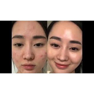Serum AHA-BHA-PHA 30 Days Miracle Serum 50ml