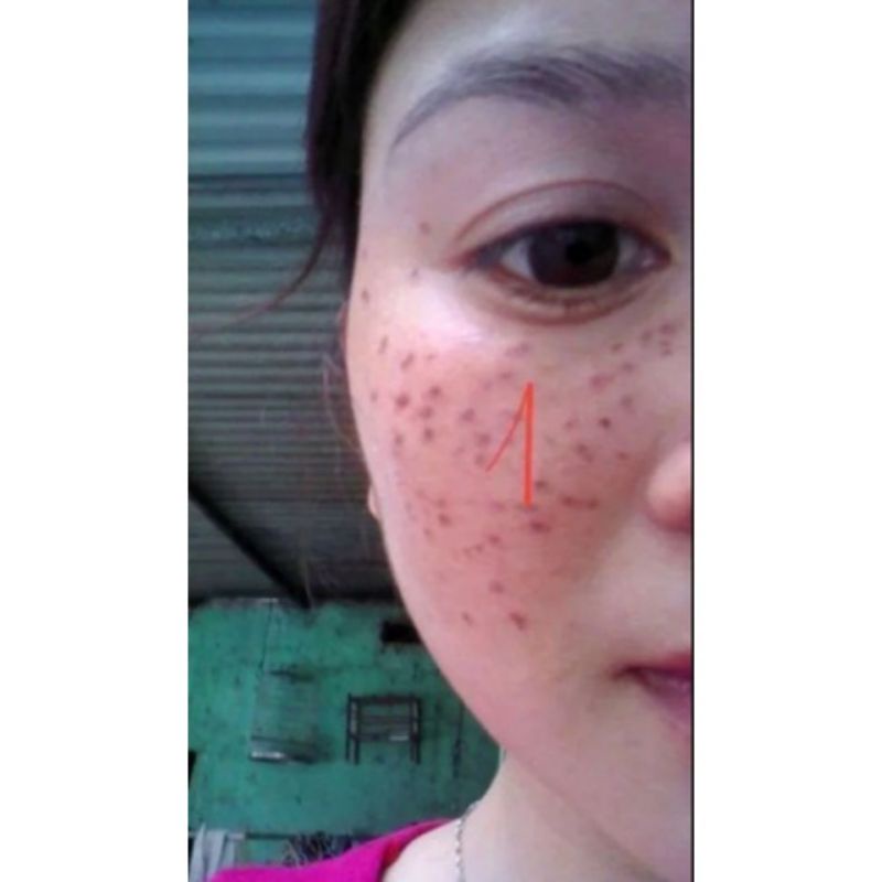 Tinh chất chấm nam ,tàn nhang ,sẹo rỗ Đức Thịnh