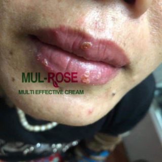 Dưỡng môi , dưỡng da,sẹo,mụn -MULROSE