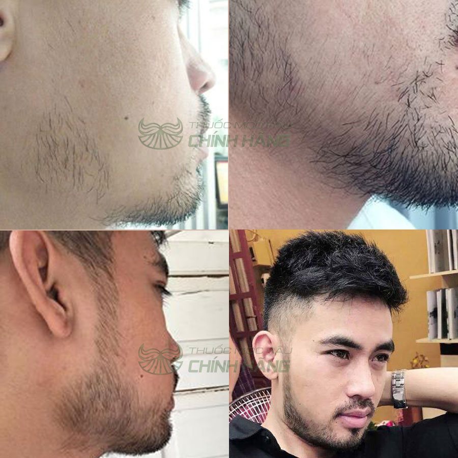 Biotin 10000 Mcg 100 Viên Của Mỹ