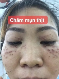 Chấm tàn nhang 7 ngày bong