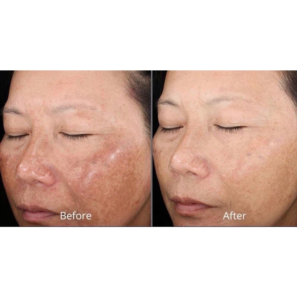 Cosmelan 2, Kem giúp giảm nám Mesoestetic