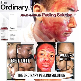 Tinh Chất The Ordinary Aha30% + Bha2% 30ml