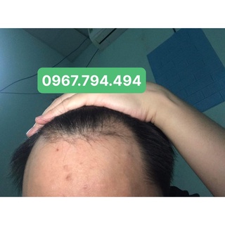 Thuốc mọc tóc Morr F5 ( MINOXIDIL 5% và 0.1% FINAS )