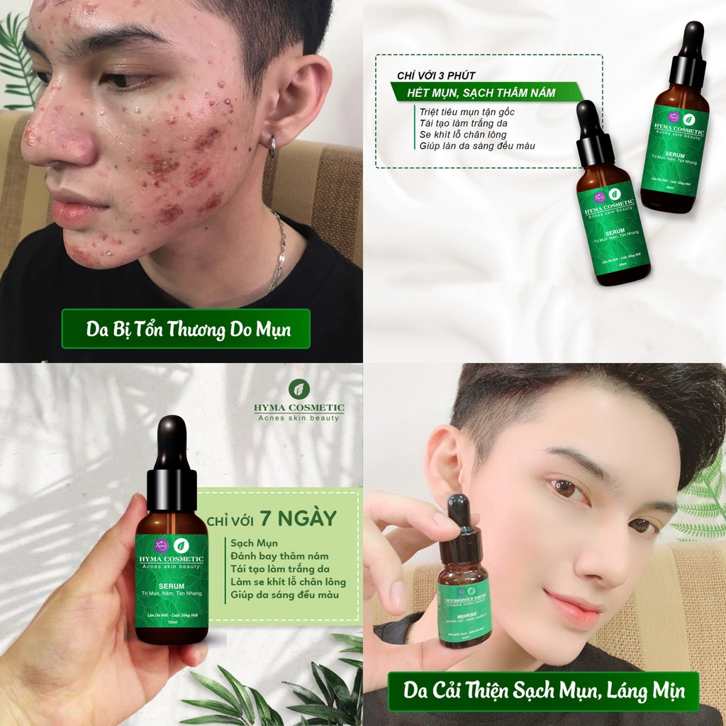 Serum giảm mụn nám sẹo thâm rỗ tàn nhang XBeauty Hyma Acnes chai 30ml/10ml. Dòng kem giảm mụn thâm sẹo rỗ