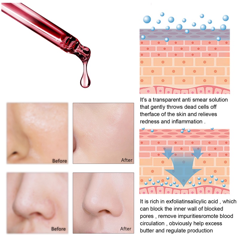 EELHOE Serum Tẩy Tế Bào Chết Mặt Chống Mụn Dung Dịch Lột Serum Thu Nhỏ Lỗ Chân Lông Kiểm Soát Dầu Làm Săn Chắc Dưỡng Ẩm Sửa Chữa Smoot-ampere