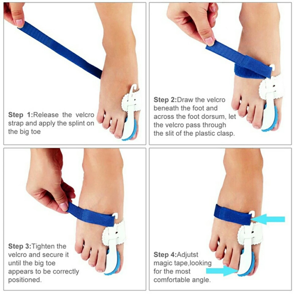 Dụng cụ nẹp định hình ngón chân cái