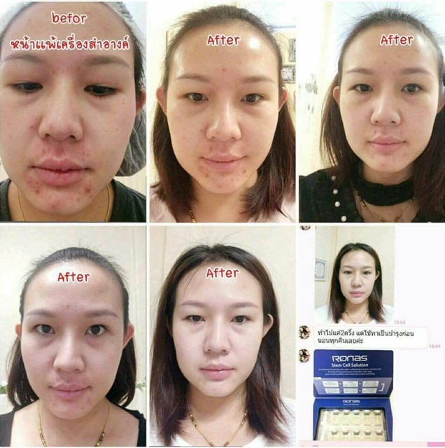 Tinh Chất Tế Bào Gốc Ronas Stem Cell Solution 5ml