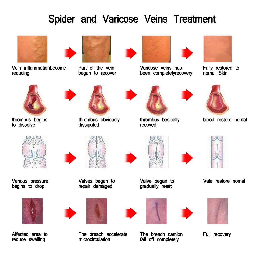 (Hàng Mới Về) Thuốc Mỡ Trị Giãn Tĩnh Mạch An Toàn Và Hiệu Quả