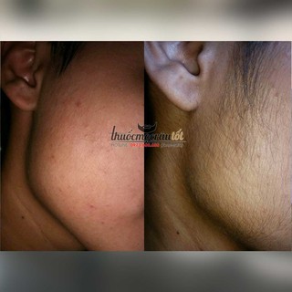 Thuốc mọc râu Minoxidil 5% dạng bọt