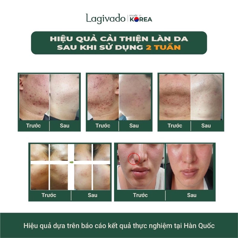 Kem giảm mụn, ngăn ngừa thâm sẹo và mụn tái phát Hàn Quốc Lagivado Dr. Atreat Cream 30 ml