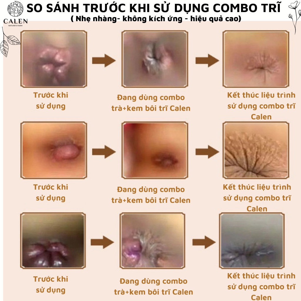 Kem bôi trĩ cấp tốc giảm đau búi trĩ cho người mắc trĩ lâu năm, dứt điểm tình trạng sa búi trĩ, đau do trĩ, ngứa hậu môn