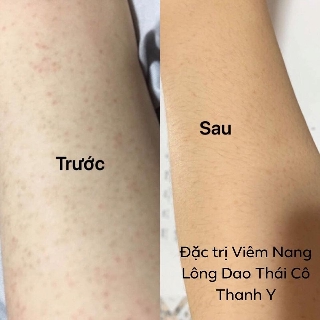 TẨY TẾ BÀO CHẾT - VIEM NANG LONG