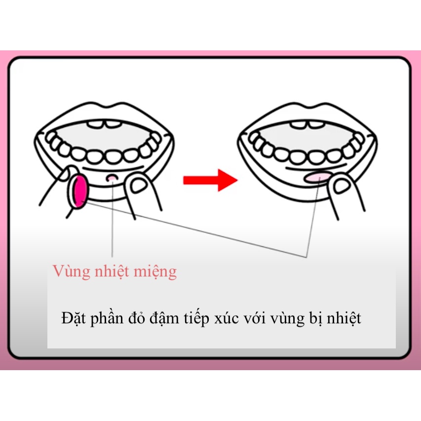 [Chuẩn Nhật] Miếng dán và kem gel bôi nhiệt miệng Taisho Nhật Bản giảm nhiệt miêng, lở miệng, loét miệng