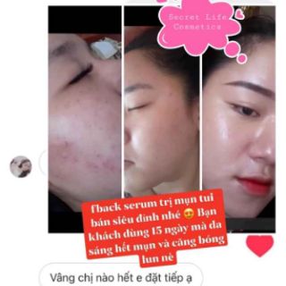 (💥CHÍNH HÃNG) Serum trị mụn Secret Life (hàng sẵn có).