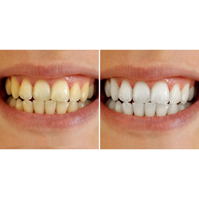 Full Combo + Quà🎁 +⚡25%] Bộ kit tẩy trắng răng tại nhà 20 minute - Made in USA