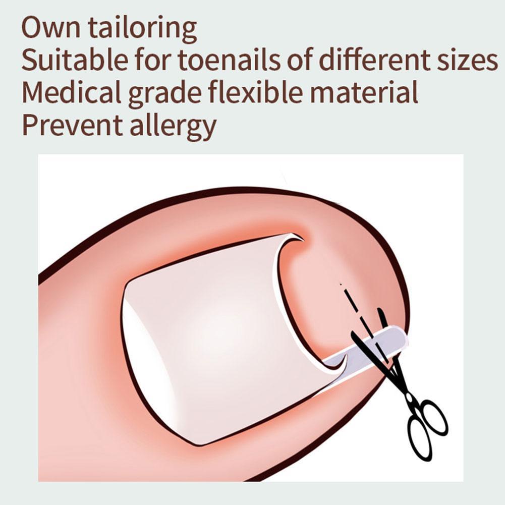 Bộ dụng cụ chỉnh hình móng chân co giãn U2W3