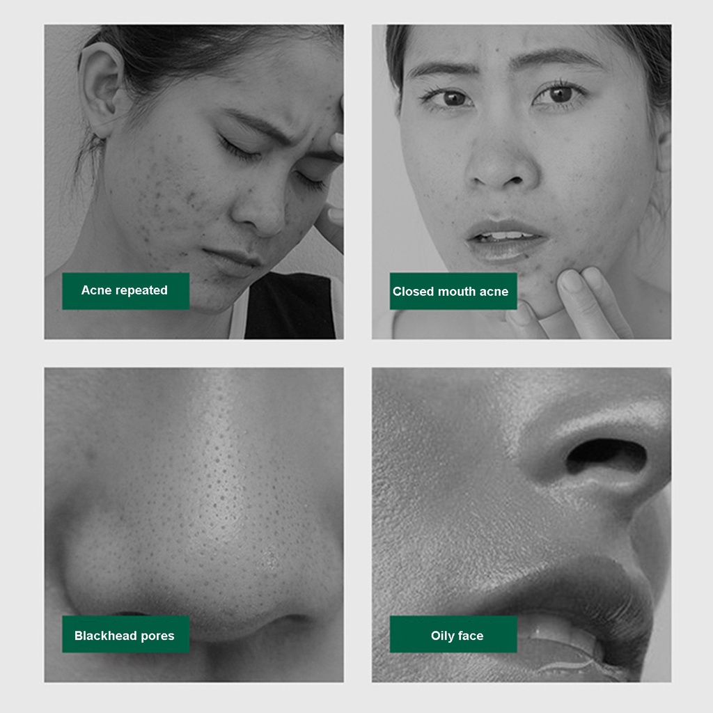 [Hàng mới về] Kem dưỡng da mặt chứa thành phần axit salicylic làm sạch lỗ chân lông và dưỡng trắng da