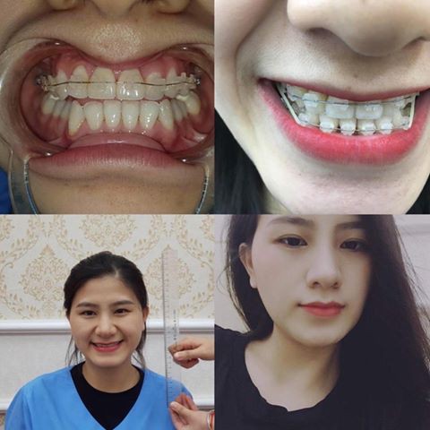 Niềng răng Pha Lê