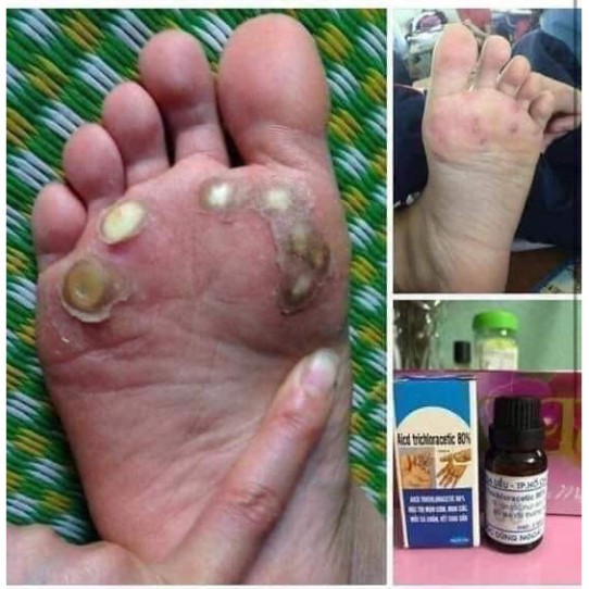 Loại Bỏ Mụn Cơm - Mụn Cóc - Mắt Cá Chân Viện Da Liễu - Acid Trivhloracetic 80% | BigBuy360 - bigbuy360.vn