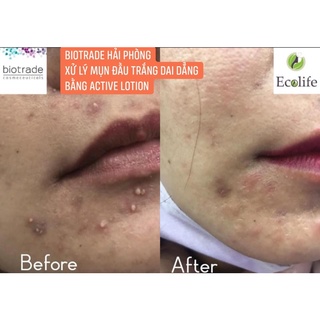 Kem Chấm Mụn - Active Cream 30ml