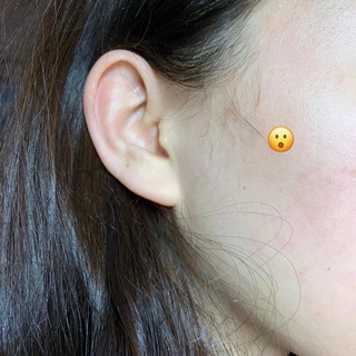 Miếng dán che mụn Somebymi 18 miếng