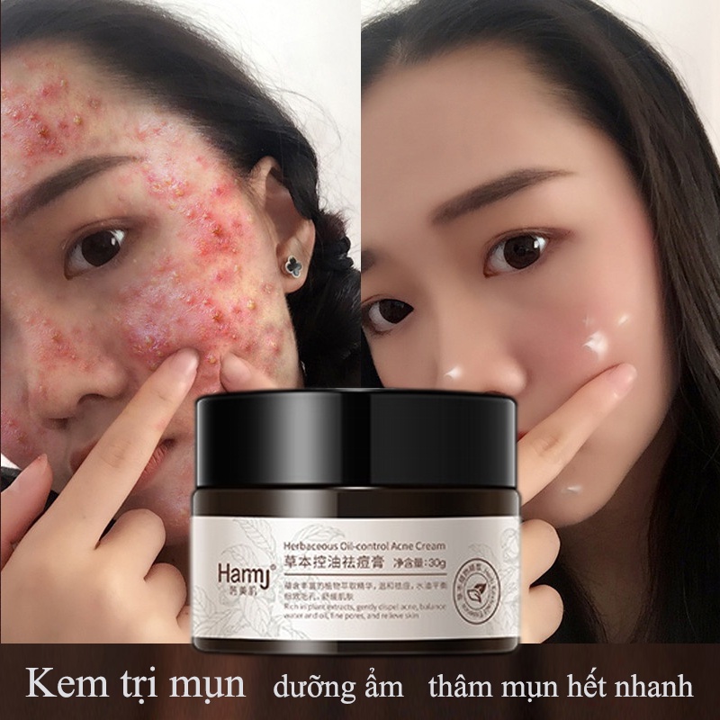 Kem Mụn 30g Thảo Dược Kiểm Soát Dầu Thâm Mụn Làm Thông Thoáng Làn Da Kem Dưỡng Ẩm Chăm Sóc Da