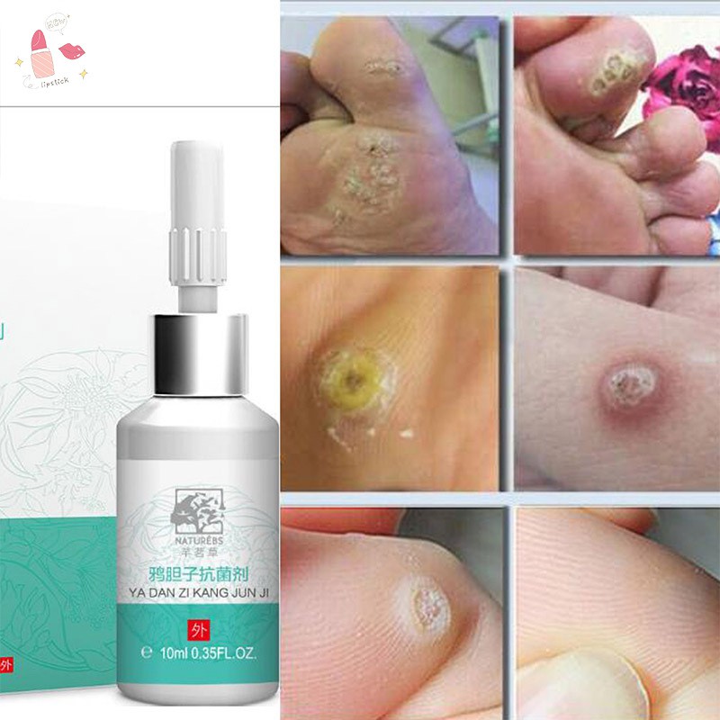 10ml Mole Skin Tag Repairing Solution Painless Tag Repair Freckle Repair Face Wart Mole Skin Cream