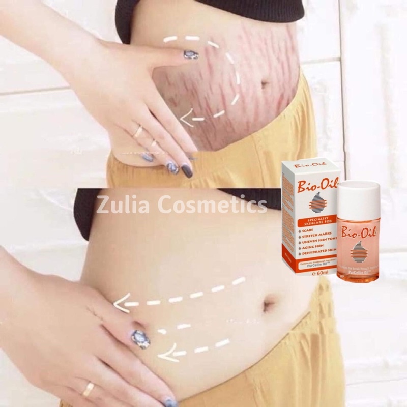 [FREE SHIP] Tinh Dầu Bio Oil Ngừa Rạn Mờ Sẹo