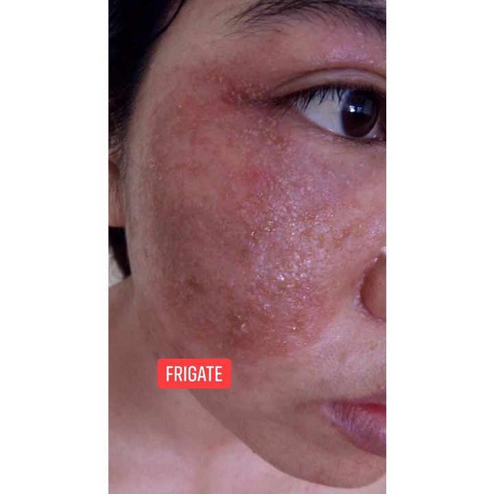 Keo Bạc FRIGATE Colloidal Silver - dành cho da mụn, da nhạy cảm, nh.iễ.m kem tr.ộ.n, demodex 30ml