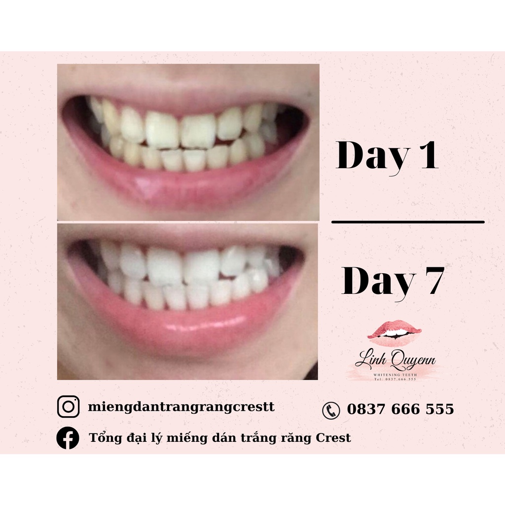 Miếng dán trắng răng Crest 3D White Glamorous &amp; Kem đánh trắng răng Radiant và Bàn chải - Combo trắng nhanh răng thường