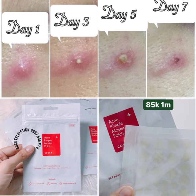Miếng Dán Mụn Cosrx Acne Pimple Master Patch
