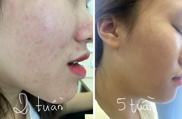 Kem Retinol A313 giảm mụn, xóa mờ vết thâm