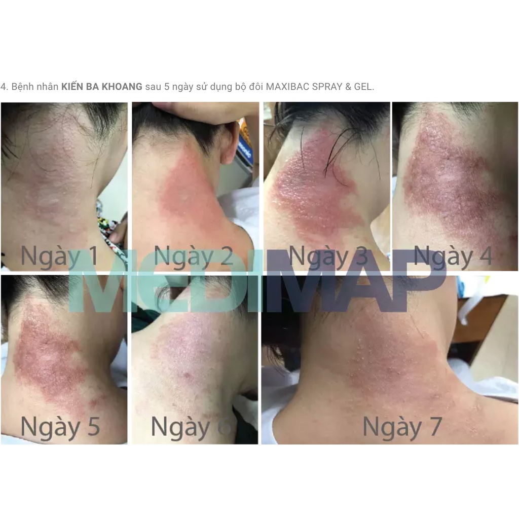 Lỡ Loét Da, Các Dạng Tổn Thương Da, Kháng Khuẩn Da Maxibac Spray & Gel, Nhanh Lành, Không Xót