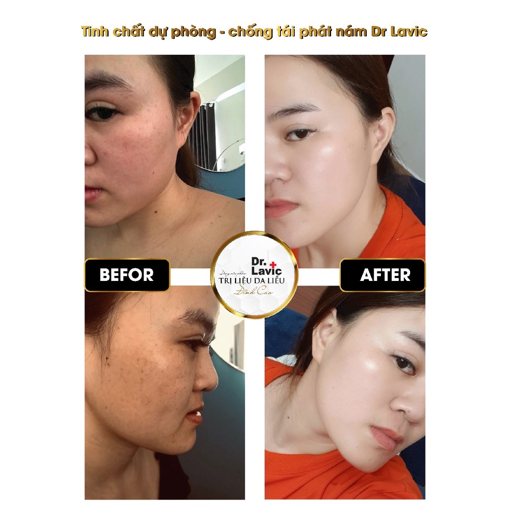 Tinh chất dự phòng chống tái phát nám nặng, đồi mồi, tàn nhang. Serum chống tái phát nám - Dr.Lavic α- MSH Serum - 10ml