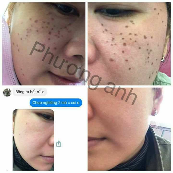 ⚡SERUM BONG NÁM RỖ YODY WHITE PHƯƠNG ANH