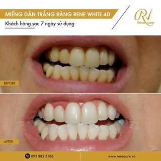 Miếng Dán Trắng Răng Rene White 4D