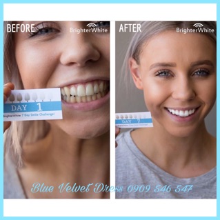 Tẩy trắng răng BrighterWhite