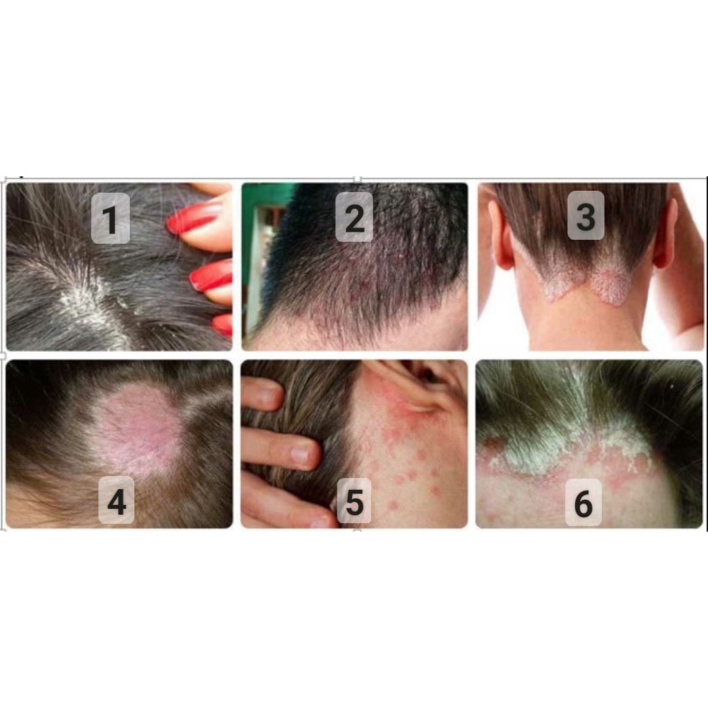 Gội Gàu Nấm DR CELL Loại Bỏ Vày Nấm, Hỗ Trợ Trị Gàu Và Nuôi Dưỡng Tóc Sâu Bên Trong