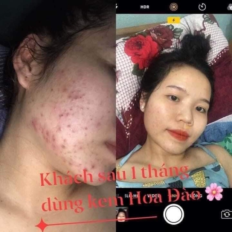 Kem khử mụn Hoa Đào dưỡng da trắng hồng sạch thâm láng mịn