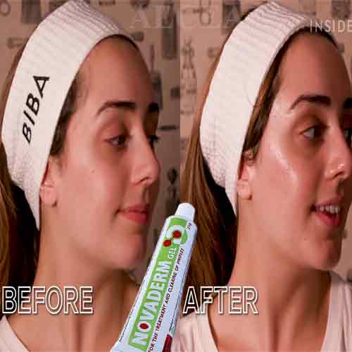 Kem Mụn Trứng Cá Gel Ngừa Mụn Mặt Thâm Thịt Đầu Đen Đầu Đỏ Sau Lưng Ẩn Bọc Đầu Trắng Tuổi Dậy Thì Novaderm