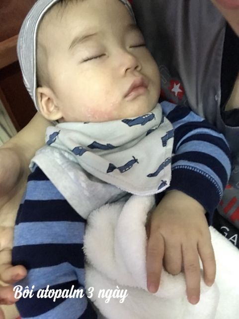 Kem Atopalm 100ml [ nhập khẩu chính hãng date 2023] | BigBuy360 - bigbuy360.vn