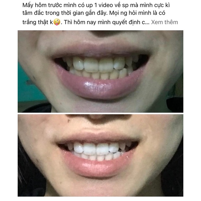 Một ống gell làm trắng răng - tẩy trắng răng - làm trắng răng hiệu quả
