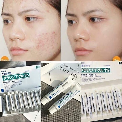 Gel giảm thâm hết  mụn Sato Saki beauty Nhật Bản 10g