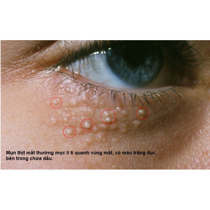 BÚT LÀM MỜ MỤN THỊT VÙNG MẮT TSUBUPORON EYE ESSENCE - NHẬT BẢN