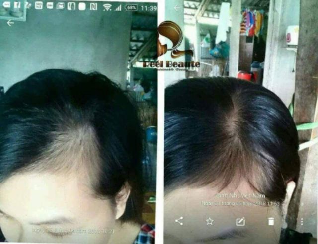 Túi lọc gội đầu #Reel Beaute trị rụng tóc